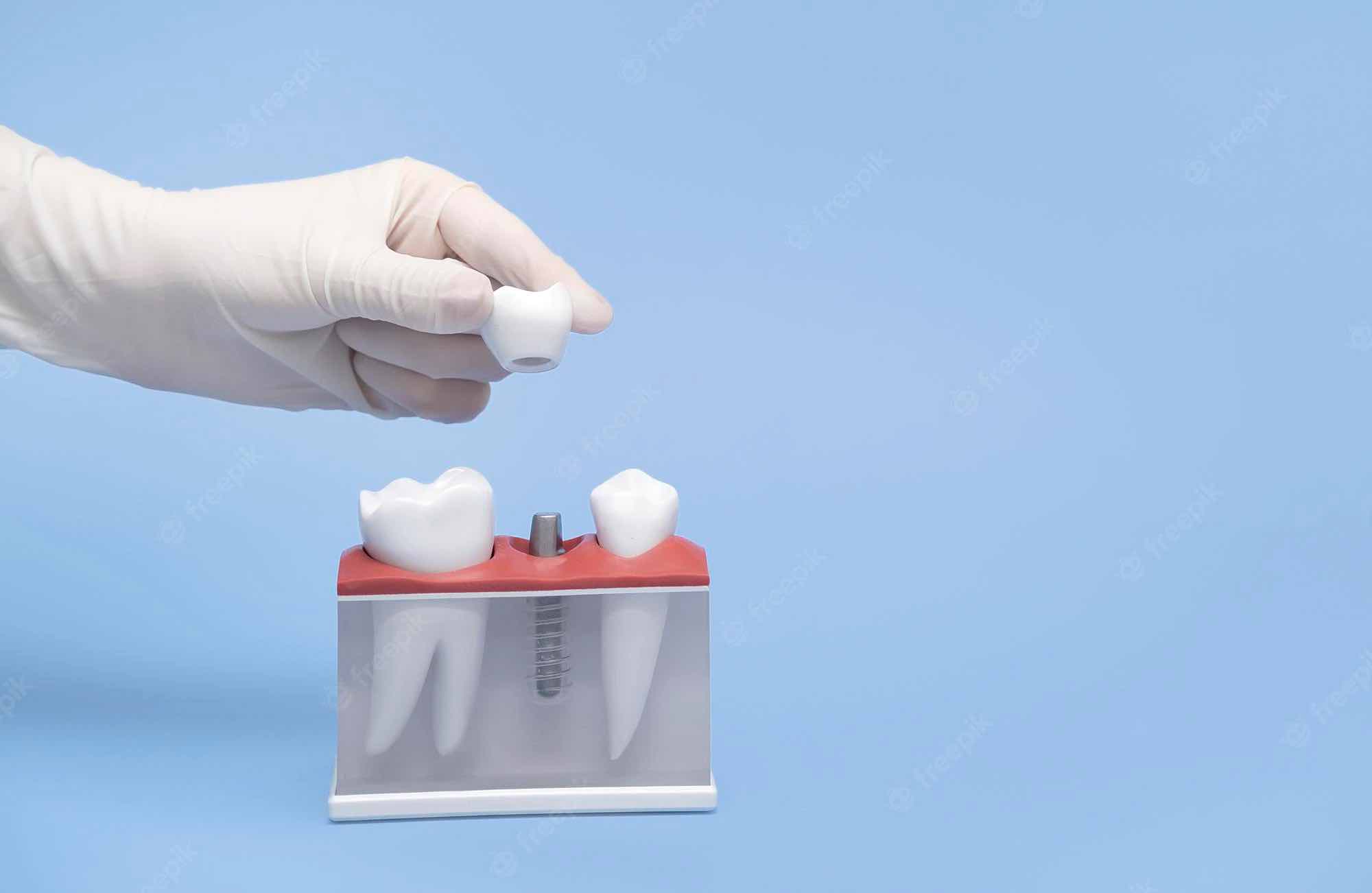 Tipos de implantes Dentales Titanio Zirconio