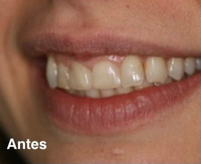 Corona dental sin metal, cuánto dura?